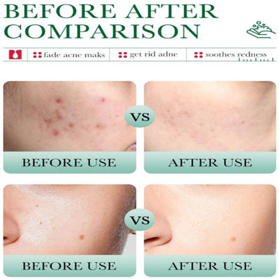 BIOAQUA Salicylic Acid Acne removal cleanser acne marks fading pores shrinking redness soothing oil controlling facial cleanser 100g BQY56297